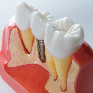 dental implants Manhattan Beach, cosmetic dentist